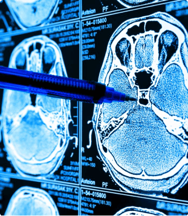Brain Hemorrhage Image Segmentation